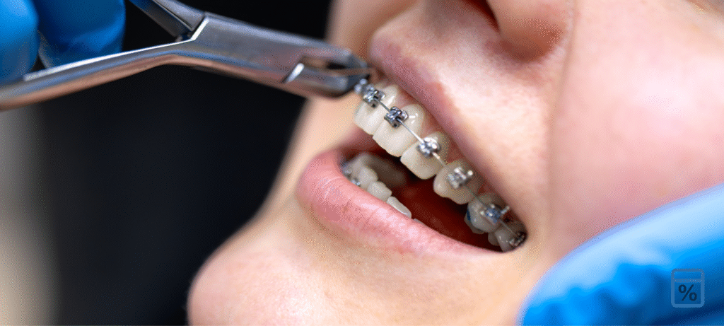 How much are braces in texas